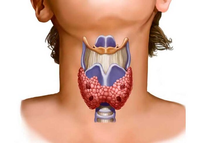 boyun ağrısı nedeni olarak tiroid sorunları