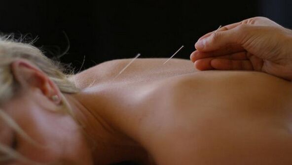sırt ağrısı için akupunktur