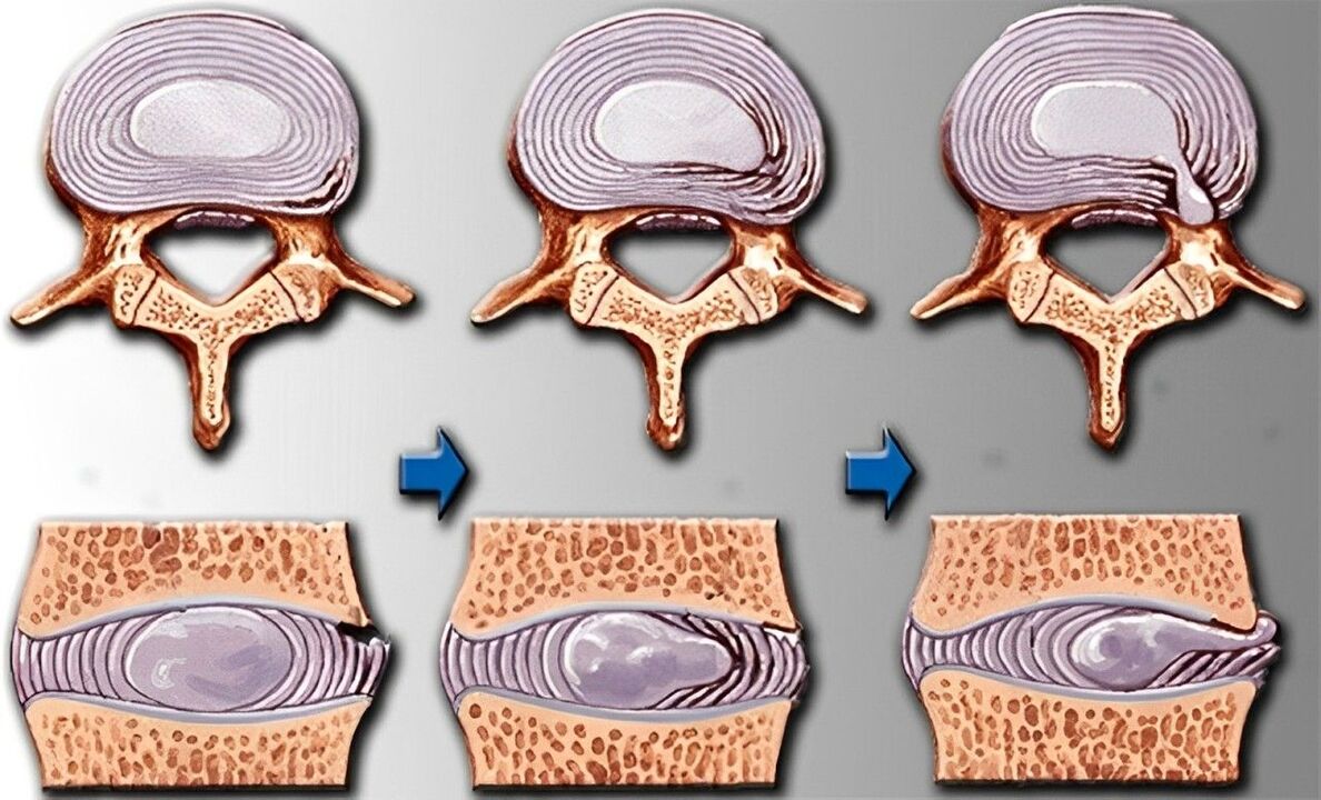 Osteokondrozun aşamaları