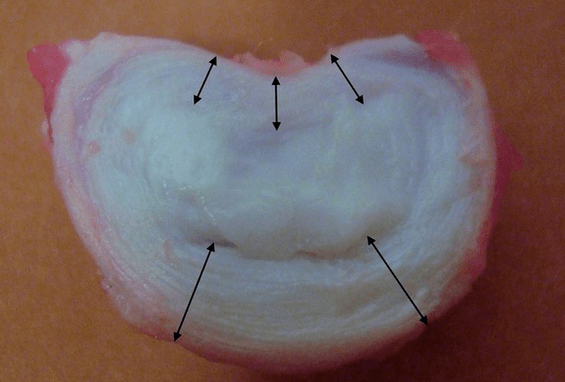 intervertebral disk neye benziyor
