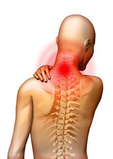 Ağrı servikal osteokondrozun ana semptomudur